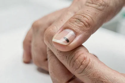 Gros plan sur un ongle présentant une tache noire longitudinale, permettant d'observer la différence visuelle entre mélanome et mycose sous-unguéale